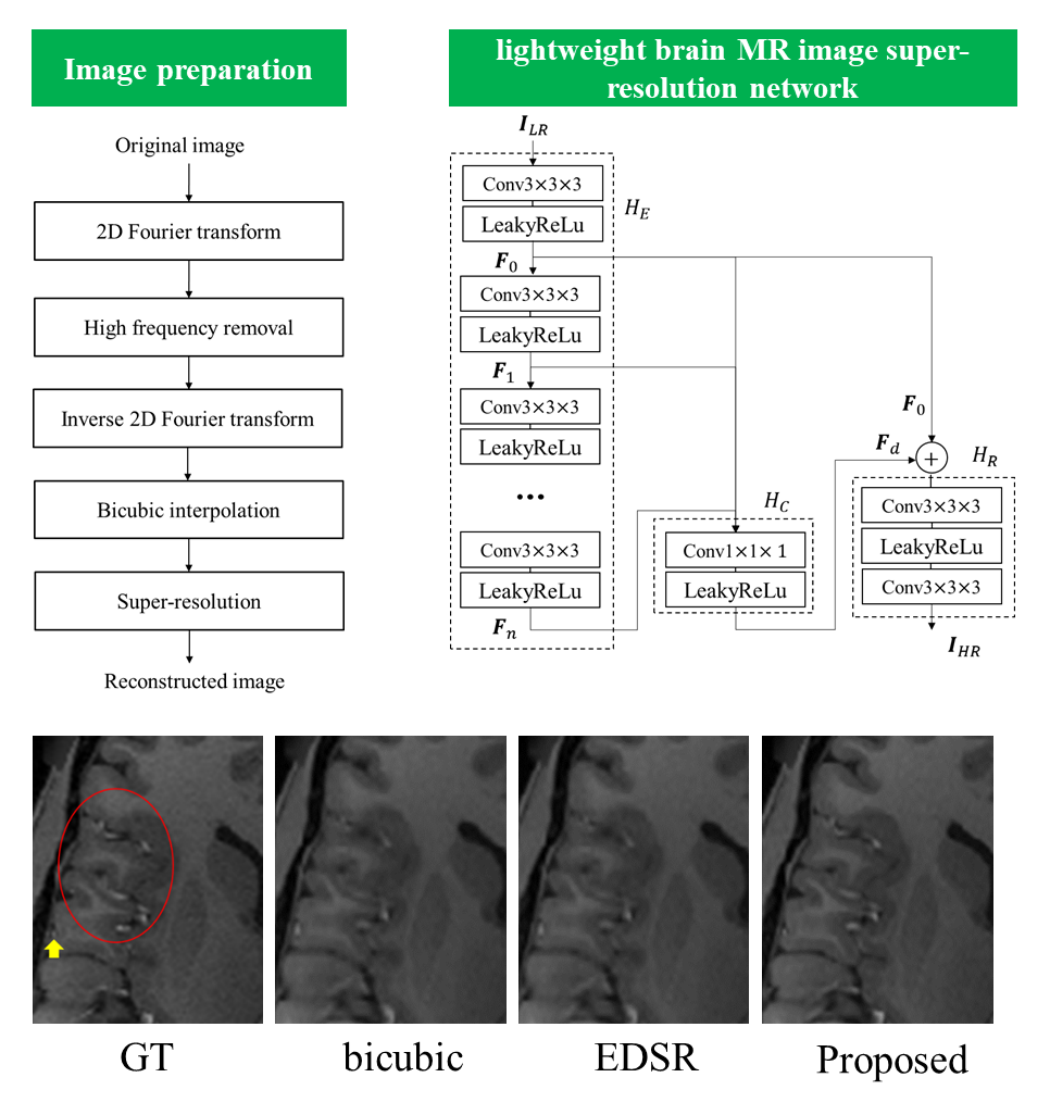 MRI Super-Resolution